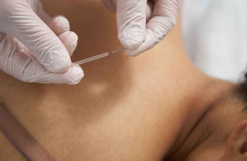 Pourquoi solliciter les services d’un acupuncteur ?