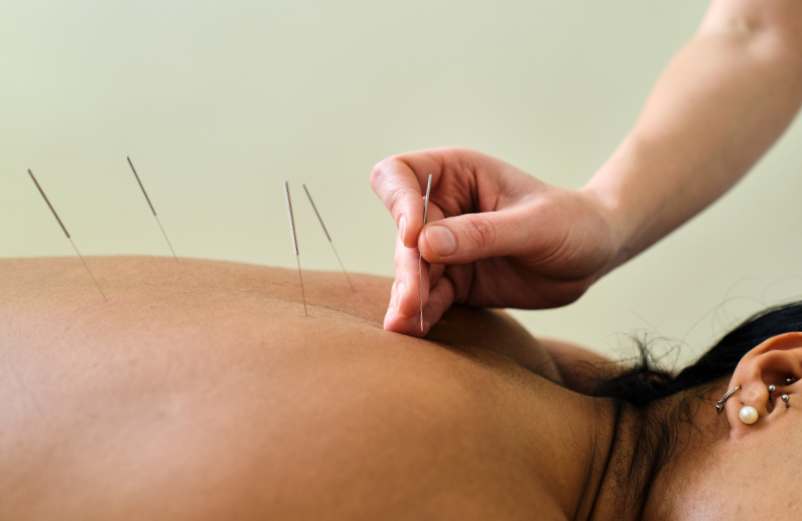 Que soigne l’acupuncture ?